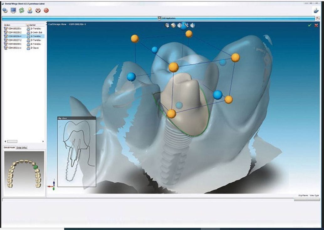 Ис кам. Моделирование вкладки в CAD cam. КАД Кам технологии в стоматологии. CAD/cam в стоматологии вкладки. Технология CAD cam в стоматологии.